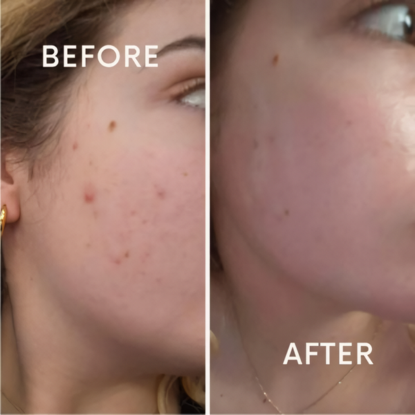 Гіалуронова сироватка для обличчя з азелаїновою кислотою Anua Azelaic Acid 10 Hyaluron Redness Soothing Serum, 30 мл AN003 фото